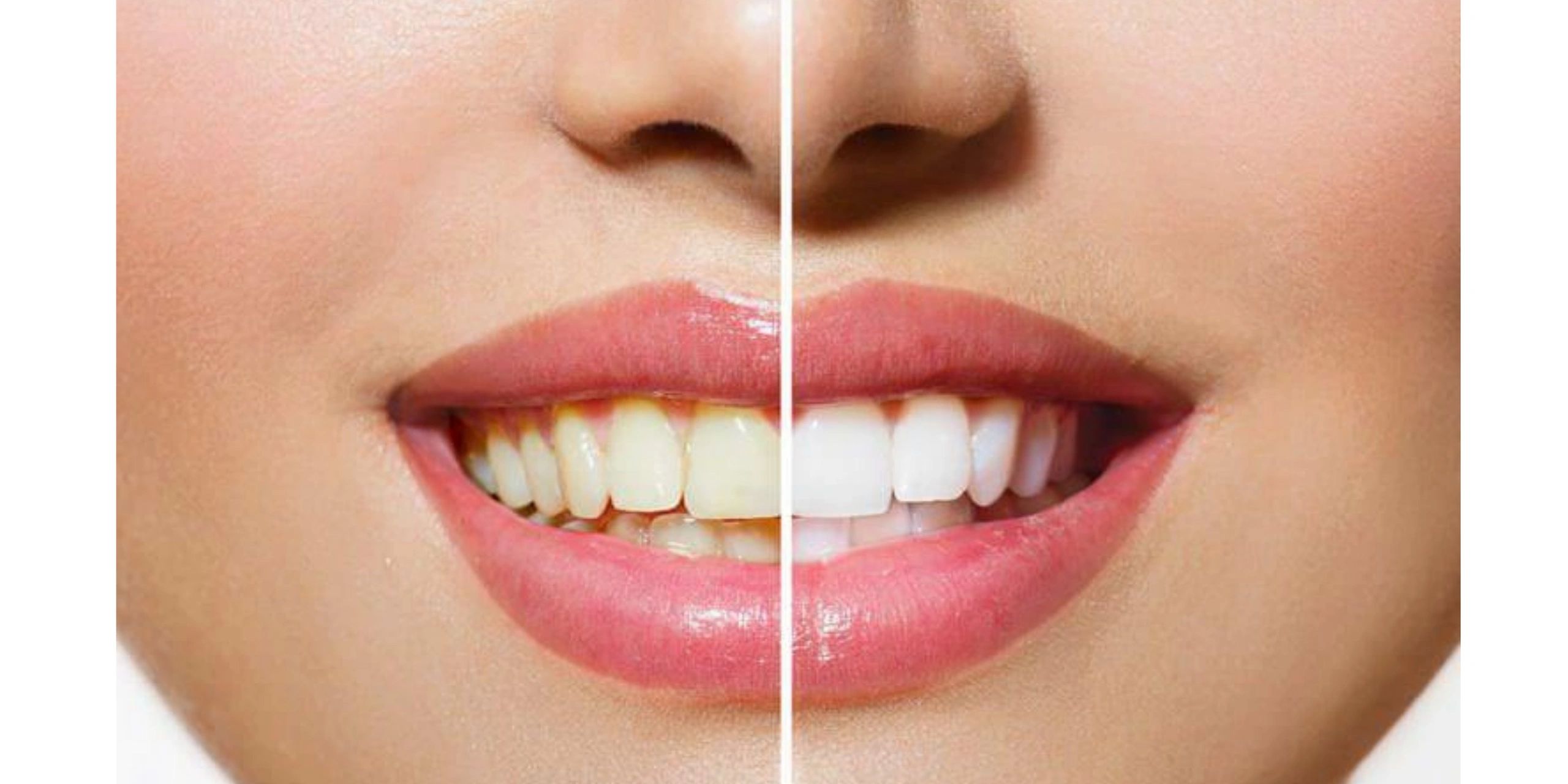 1 Hour Teeth Whitening